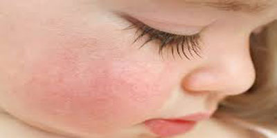 بیماری ها و حساسیت های پوستی کودک