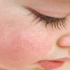 بیماری ها و حساسیت های پوستی کودک